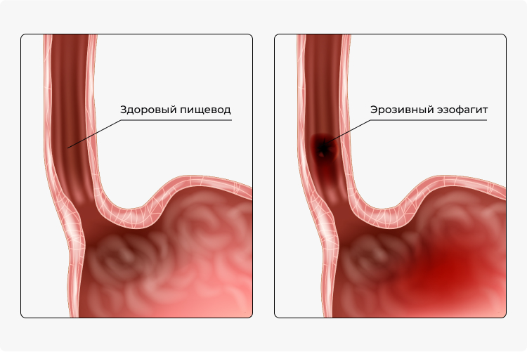Иллюстрация здорового пищевода (слева) и эрозовного эзофагита (справа)