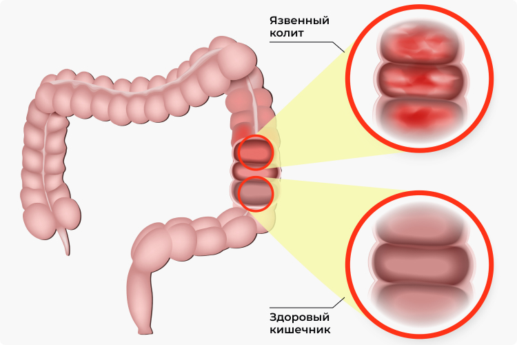 Иллюстрация заболевания кишечника