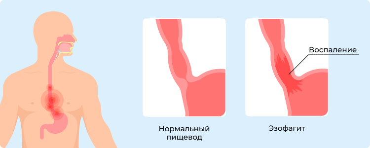 Иллюстрация нормального пищевода (слева) и эзофагита (справа)