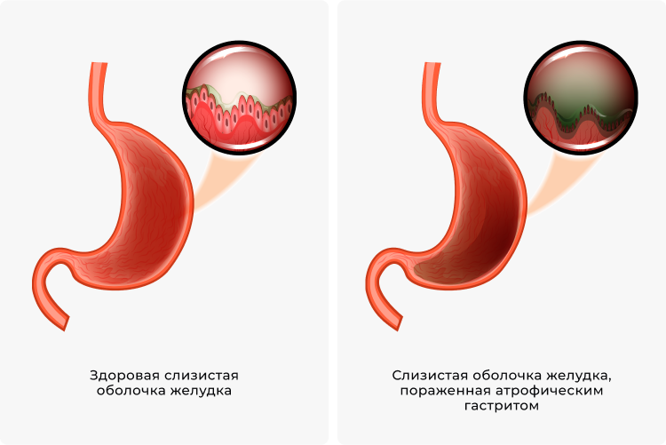 Иллюстрация здоровой слизистой оболочки желудка и слизистой оболочки желудка, пораженной атрофическим гаститом