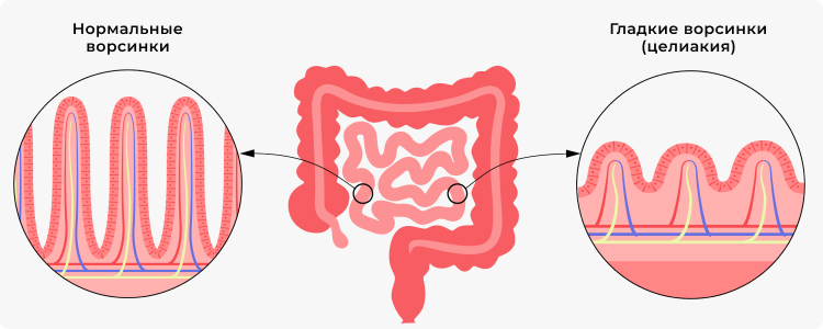 Иллюстрация слизистой кишечника в здоровом состоянии (слева) и при целиакии (справа)