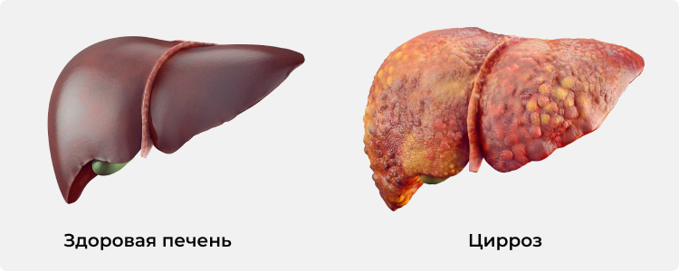 Иллюстрация сравнение здоровой печени и цирроза печени