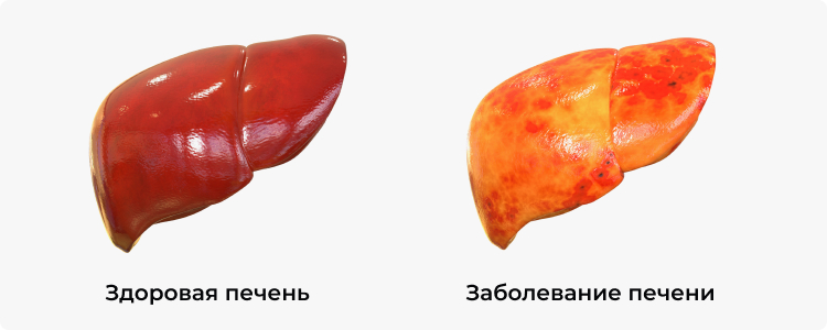 Иллюстрация сравнение здоровой печени и заболевание печени
