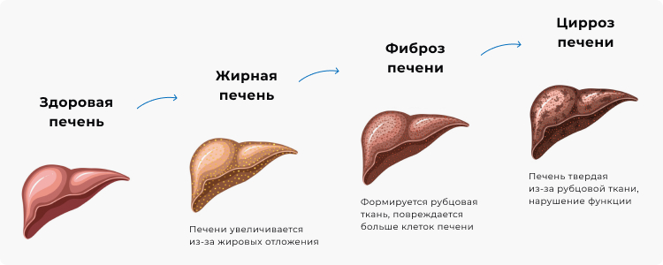 Рисунок с изображением стадий развития стеатоза печени.