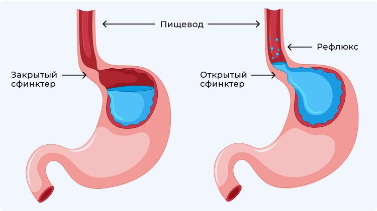 Иллюстрация здорового ЖКТ (слева) и ЖКТ с рефлюкс-эзофагитом (справа)